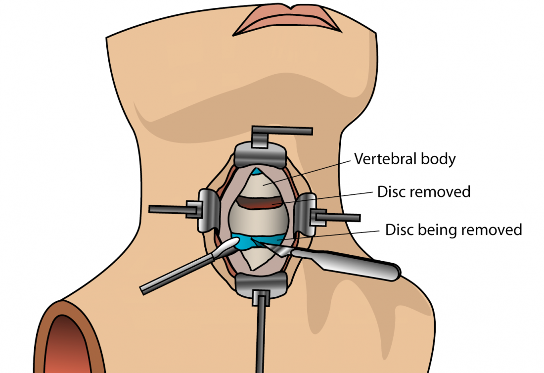 Cervical Spine Surgery – Microdiscectomy