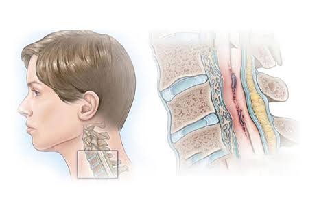 Cervical Myelopathy