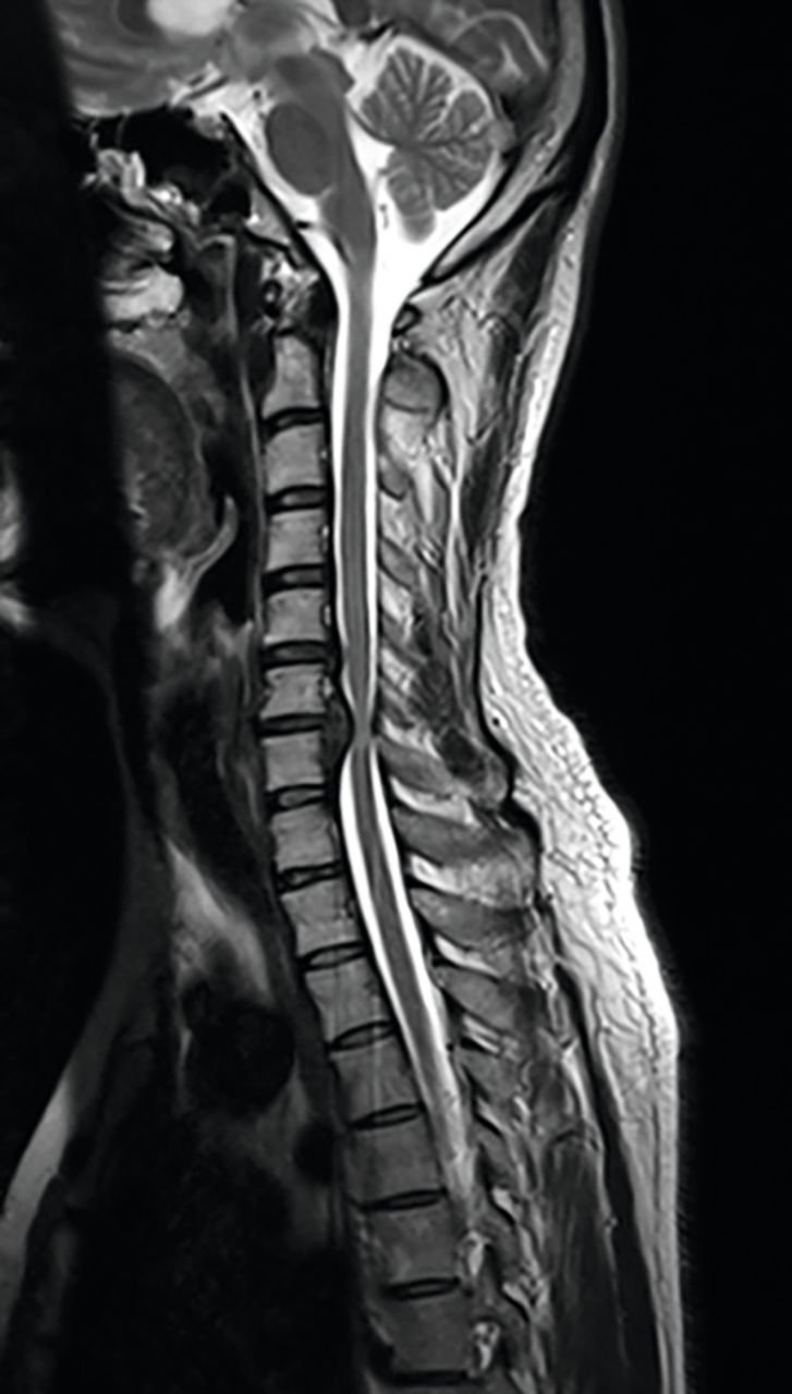 Kyphosis