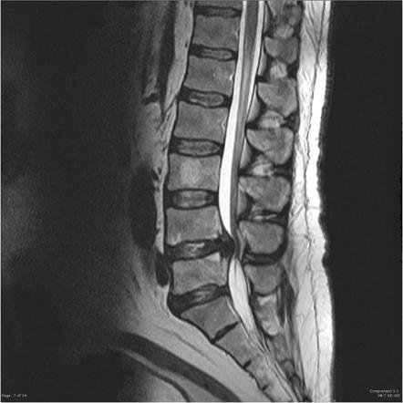 Lumbar Canal Stenosis