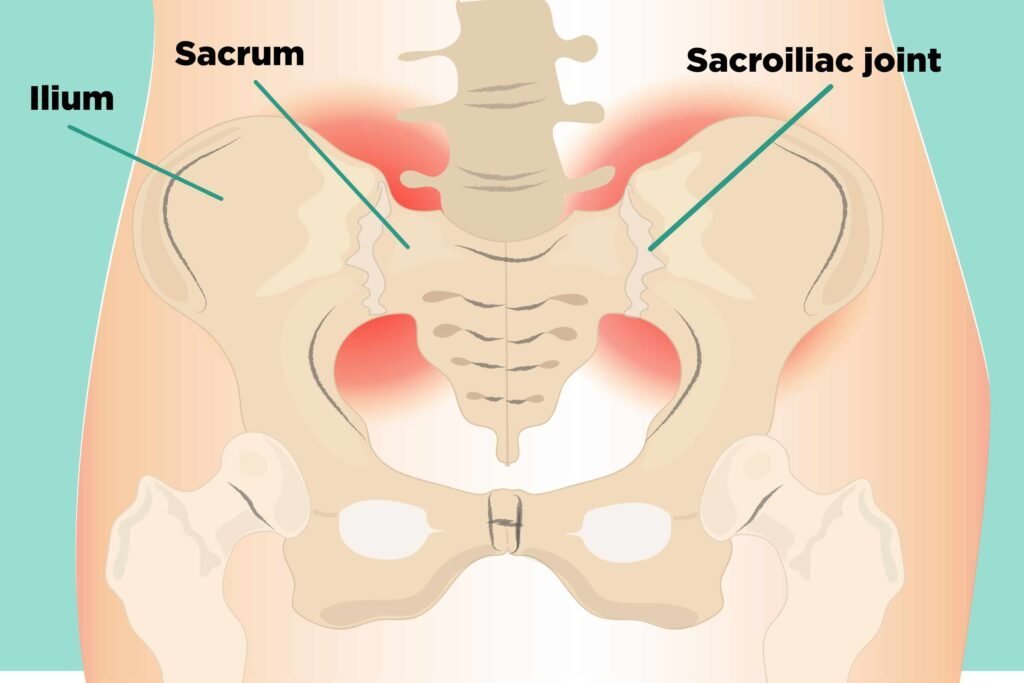Sacroiliitis