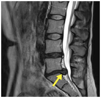Slip disc Surgery (Herniated disc)